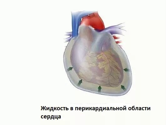 Скопление воздуха и крови в перикарде. Гидроперикард тампонада сердца. Водянка сердца гидроперикард. Гидроперикард рентгенография.