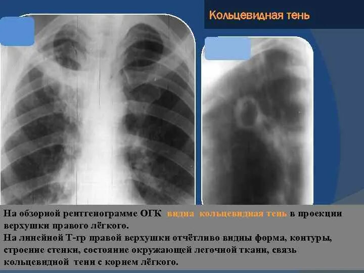 Кольцевидные тени в легких на рентгене. Синдром кольцевидной тени на рентгенограмме легких. Кольцевидная тень легкого рентген. Кольцевидная тень на рентгенограмме легких.