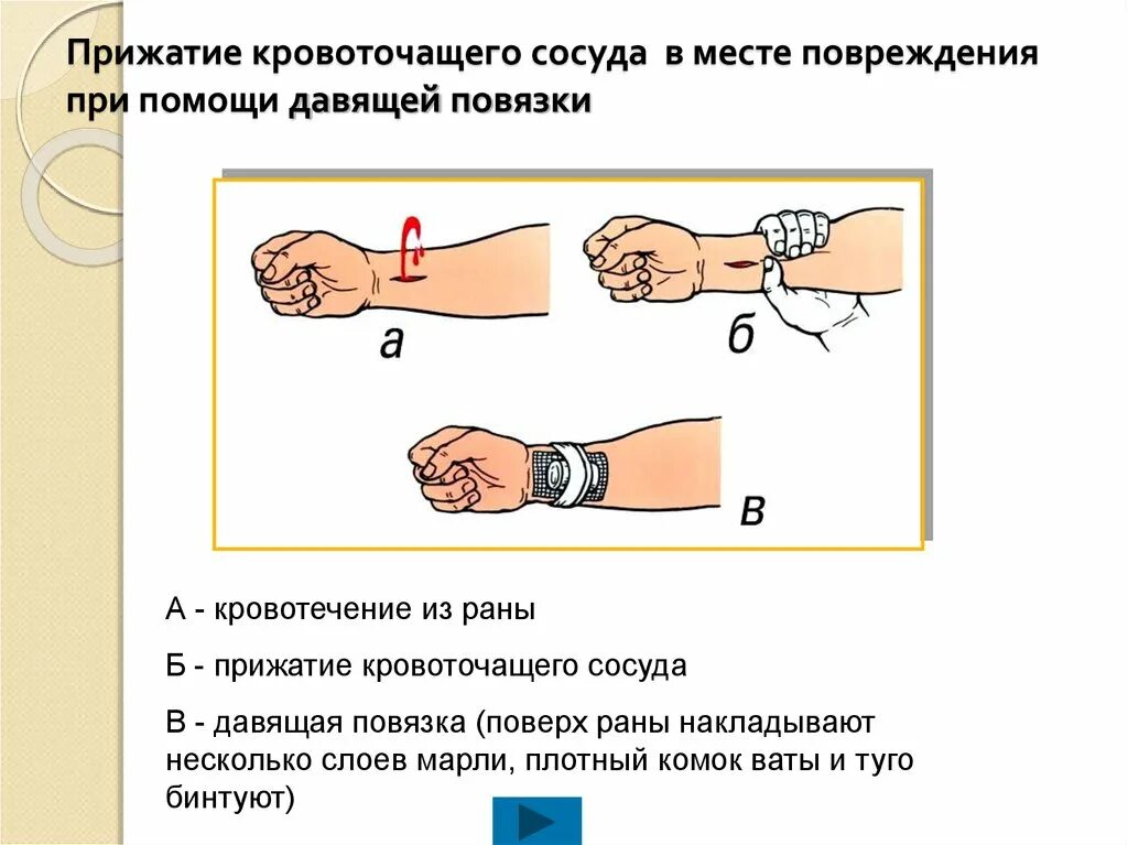 Техника наложения давящей повязки при кровотечении