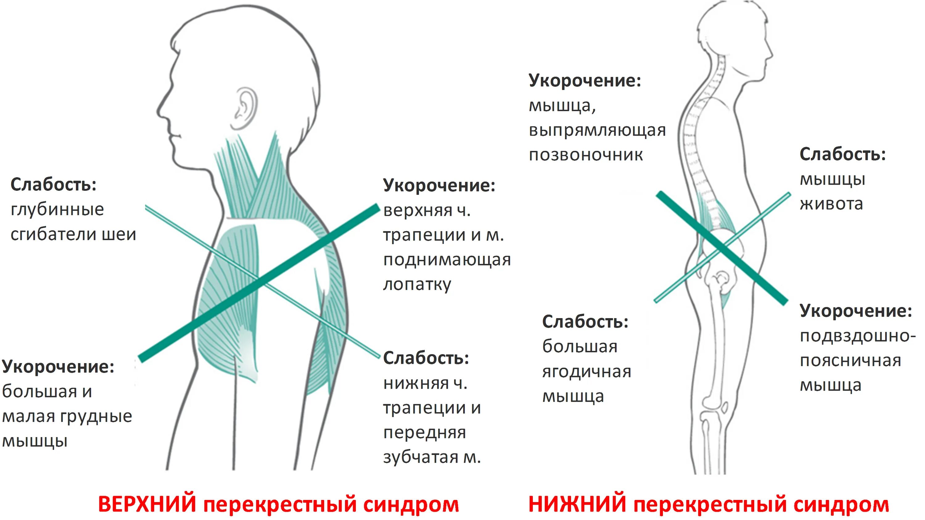 Верхний перекрестный синдром. Верхний перекрестный синдром упражнения для исправления осанки. Верхний и Нижний перекрестный синдром. Верхний перекрестный синдром мышц. Спин удлинит