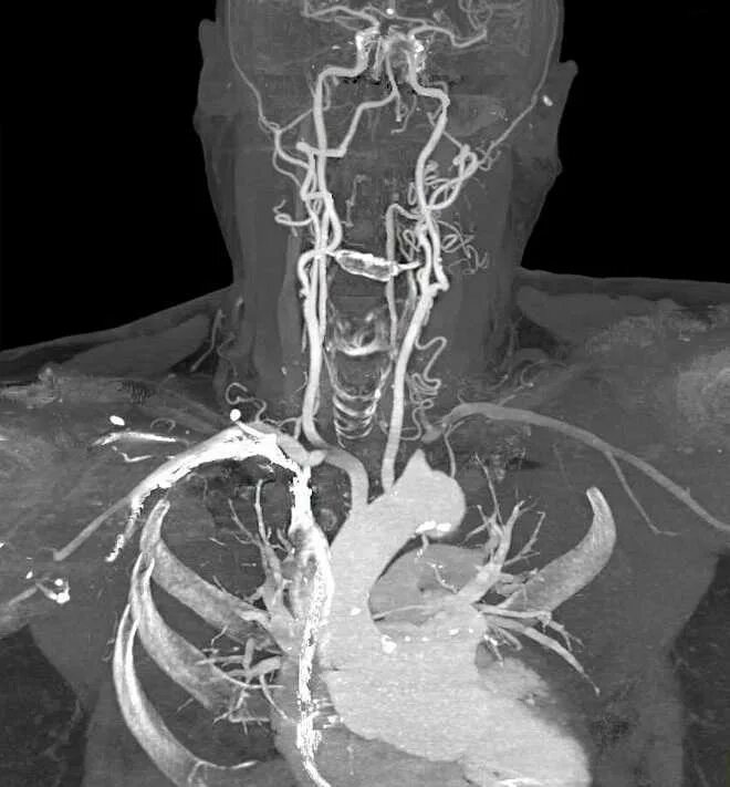 Мрт ангиография артерий головного мозга. Брахиоцефальные артерии кт. МР-ангиография артерий шеи. Кт ангиография брахиоцефальных артерий.