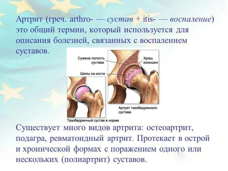 Воспаление суставов болезнь