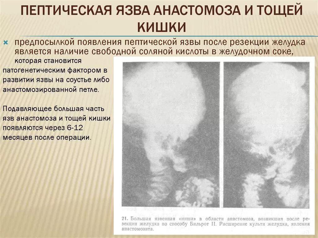 Послеоперационная язва. Пептические язвы после Бильрот 2. Пептическая язва анастомоза. Анастомозит после резекции желудка. Пептическая язва гастроэнтероанастомоза.