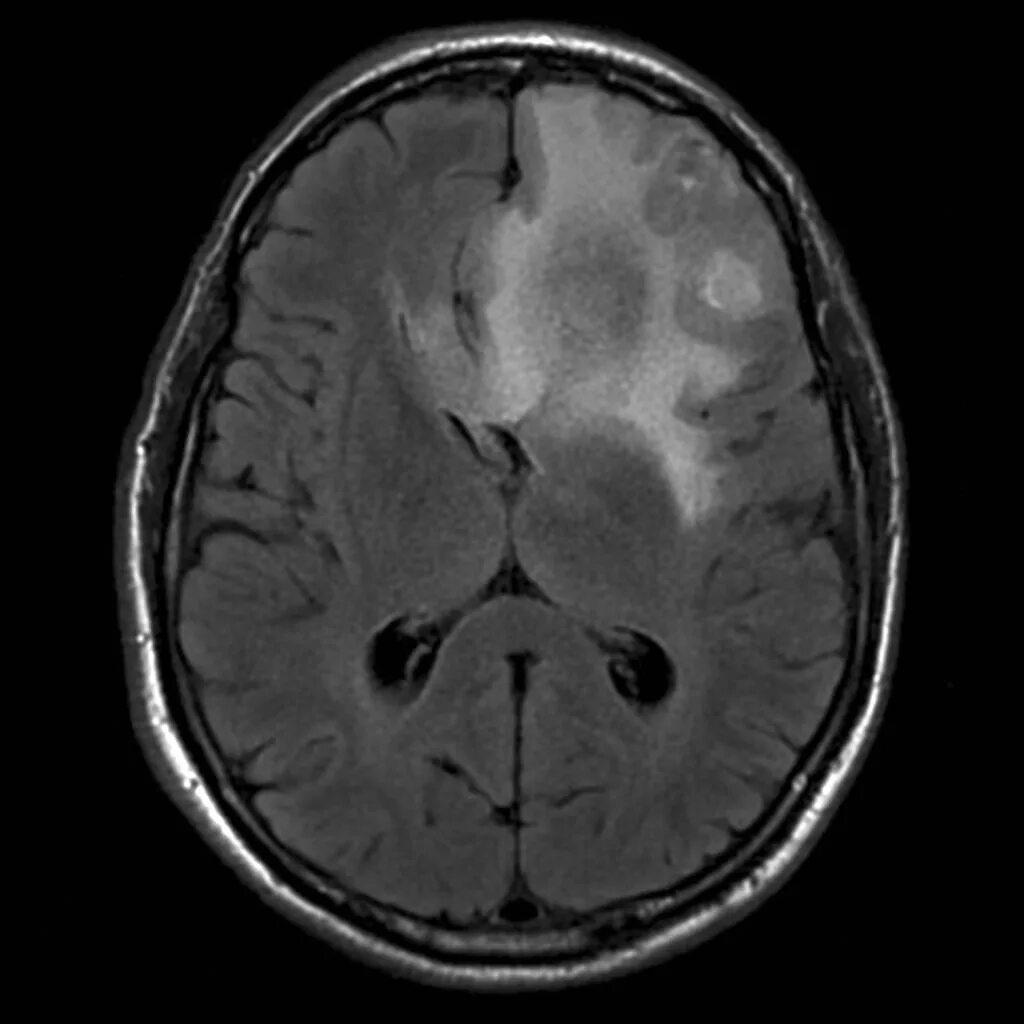 Глиома головного мозга кт. Глиобластома головного мозга на кт.