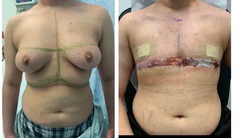 Female to Male Procedures Miami - Transition Care Coconut Grove