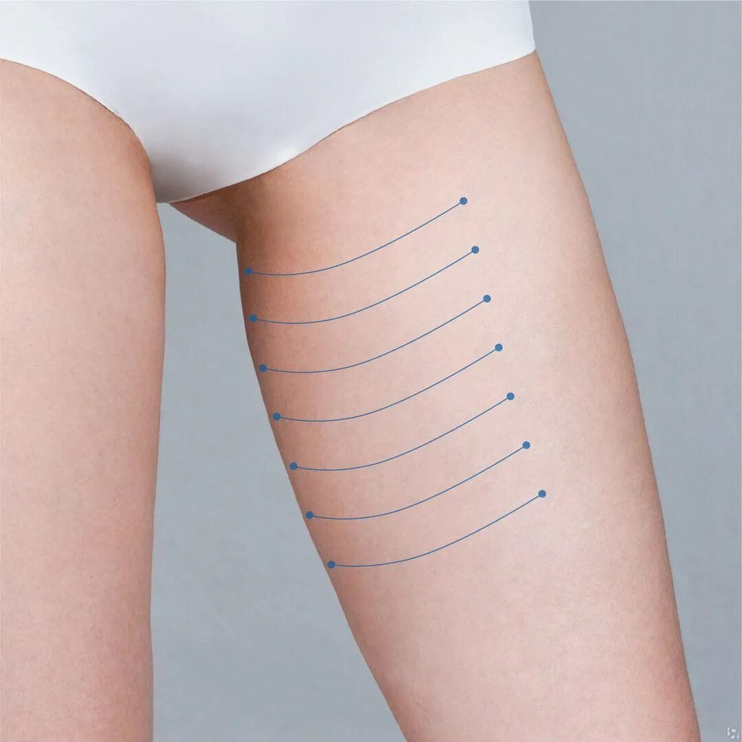 Внутренняя поверхность тела. Нити aptos body. мезонити для подтяжки живота. мезонити для подтяжки тела.