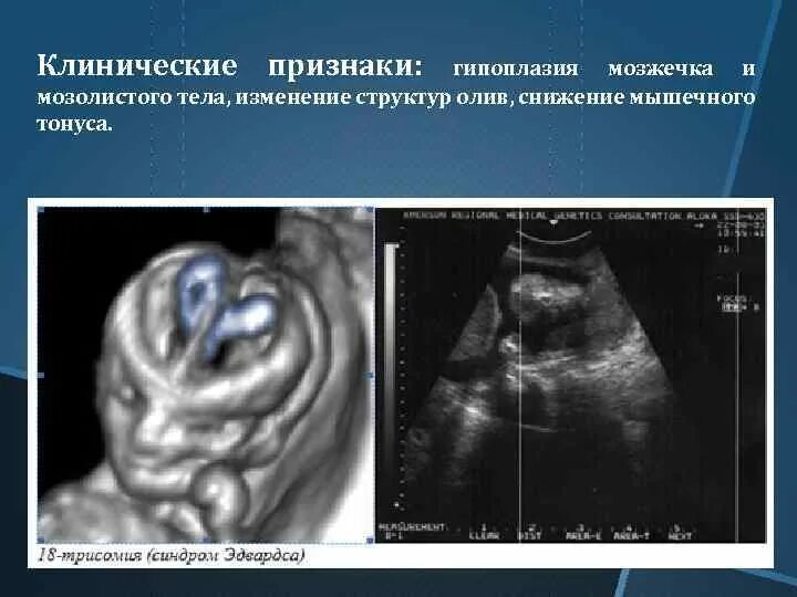 Синдром Эдвардса УЗИ 1 скрининг. УЗИ первый скрининг синдром Дауна. УЗИ плода на 12 неделе беременности с синдромом Дауна. Синдром Эдвардса УЗИ 2 скрининг.