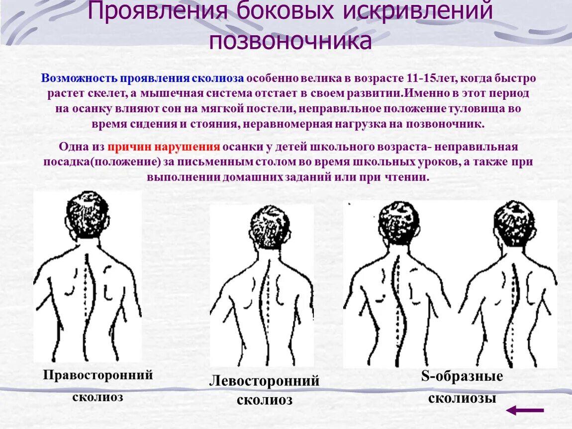 Локальный статус позвоночник. Сколиоз позвоночника левосторонний. Сколиоз позвоночника сбоку. Правосторонний сколиоз степени. Левосторонний s образный сколиоз 2 степени.