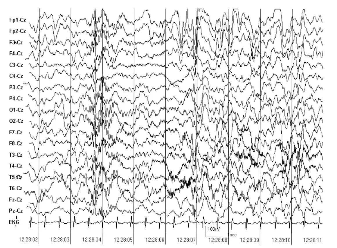 Эпи ээг. Гипсаритмия на ЭЭГ. Эпилептиформные паттерны на ЭЭГ. Гипсаритмия паттерны на ЭЭГ. Интериктальный паттерн на ЭЭГ.