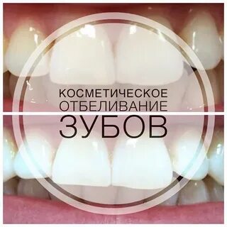 Косметическое отбеливание