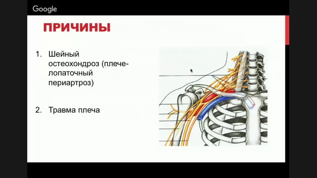 Остеохондроз боли в плече. Шейно-плечевой остеохондроз. Остеохондроз плечевого сустава. Шейно-лопаточный остеохондроз. Плечевой остеохондроз симптомы.