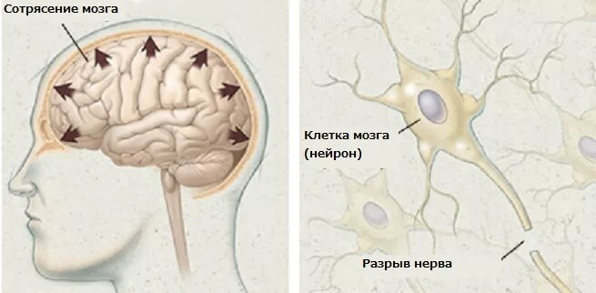 Снимок головного мозга при сотрясении.