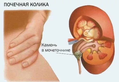 Заболевание почечная колика. Мочекаменная болезнь почечная колика. Почечно-каменная болезнь почечная колика. :Мочекаменная болезнь,почечный коллек. Колика при мочекаменной болезни.