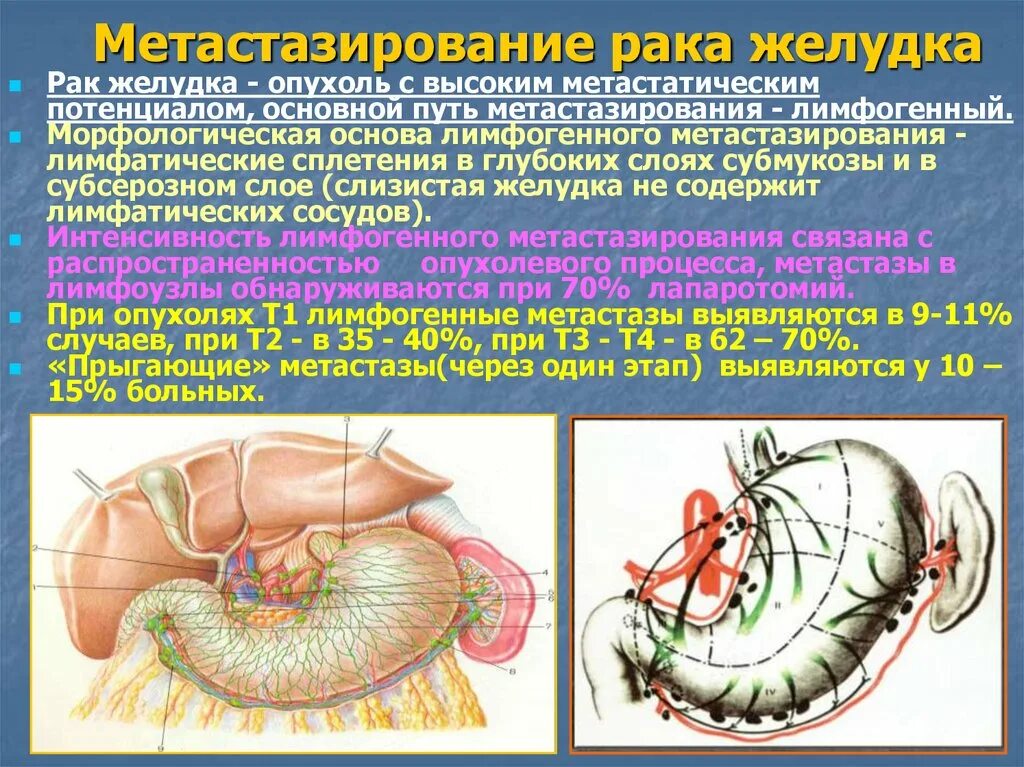 Пути метастазирования рака. Пути метастазирования желудка. Опухоль желудка метастазирование. Желудок этапы метастазирования. Основные пути метастазирования опухолей.