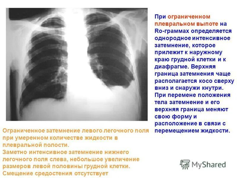 однородное затемнение на рентгенограмме. плевральный выпот слева. гнойный плеврит рентген. плевральный выпот слева. плевральный выпот слева.