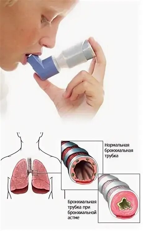 Аллергия и бронхит. Аллергическая бронхиальная астма. Аллергический бронхит и астма. Бронхиальная астма легкие. Легкие при бронхиальной астме.