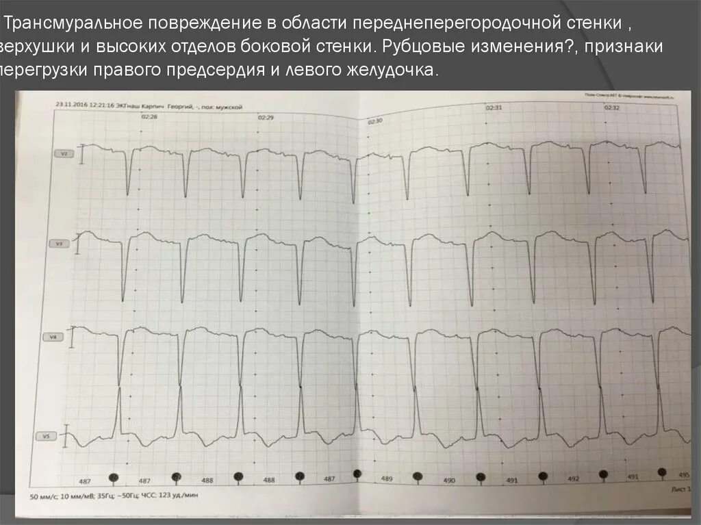 Рубцовые изменения боковой стенки. Рубцовые изменения передней боковой стенки левого желудочка. Рубцовые изменения в задней стенке. Рубцовые изменения переднеперегородочно боковой области. Изменение боковой стенки левого желудочка