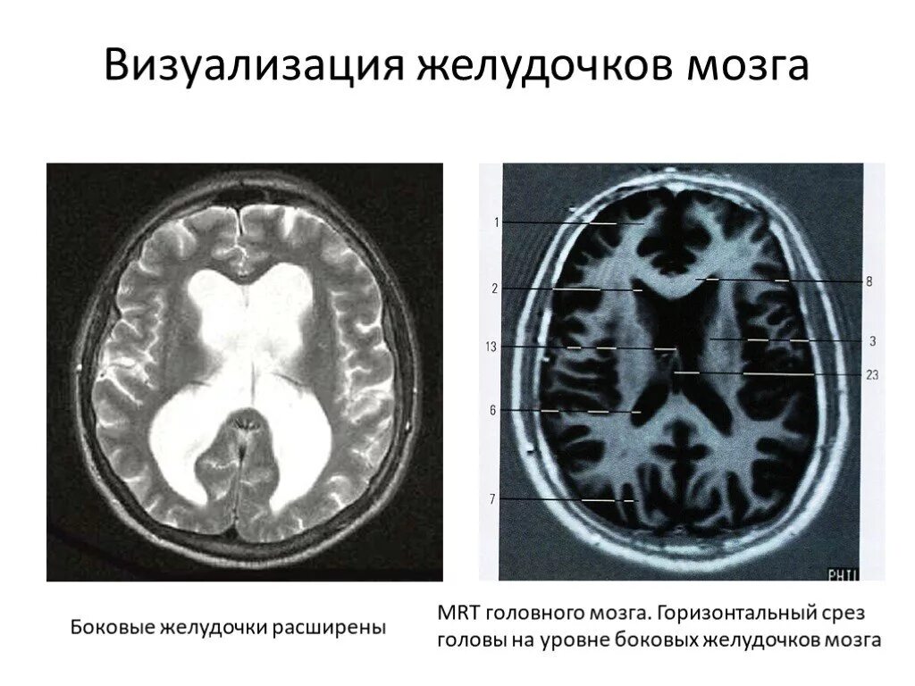 Дилатация бокового желудочка мозга. Боковые желудочки мозга на срезе. Мрт головного мозга расширены желудочки. Мрт анатомия желудочков мозг. Мрт головного мозга горизонтальный срез.