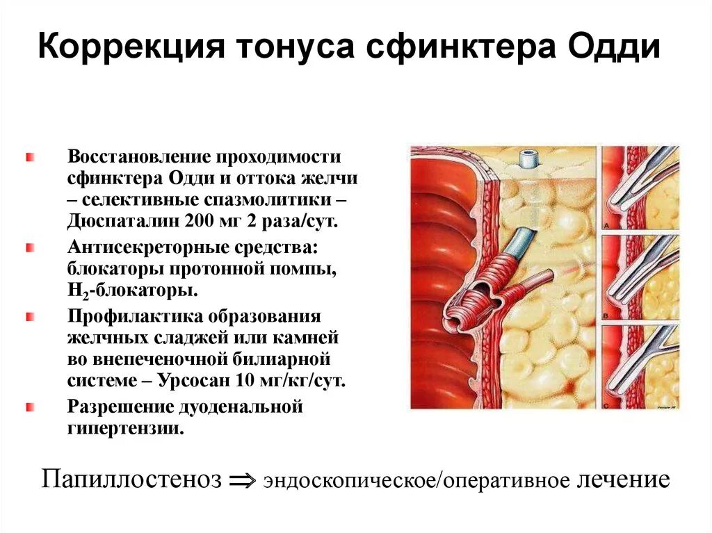 Снять спазм сфинктера при трещине. Операция на сфинктере Одди. Дисфункция сфинктера Одди. Сфинктер Одди расположение. Гипертонус сфинктера Одди.