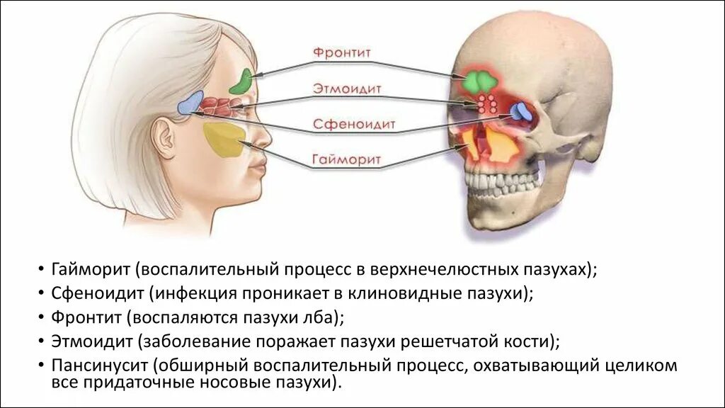 Верхнечелюстной синусит, фронтит, этмоидит. Гайморовы пазухи сфеноидит.