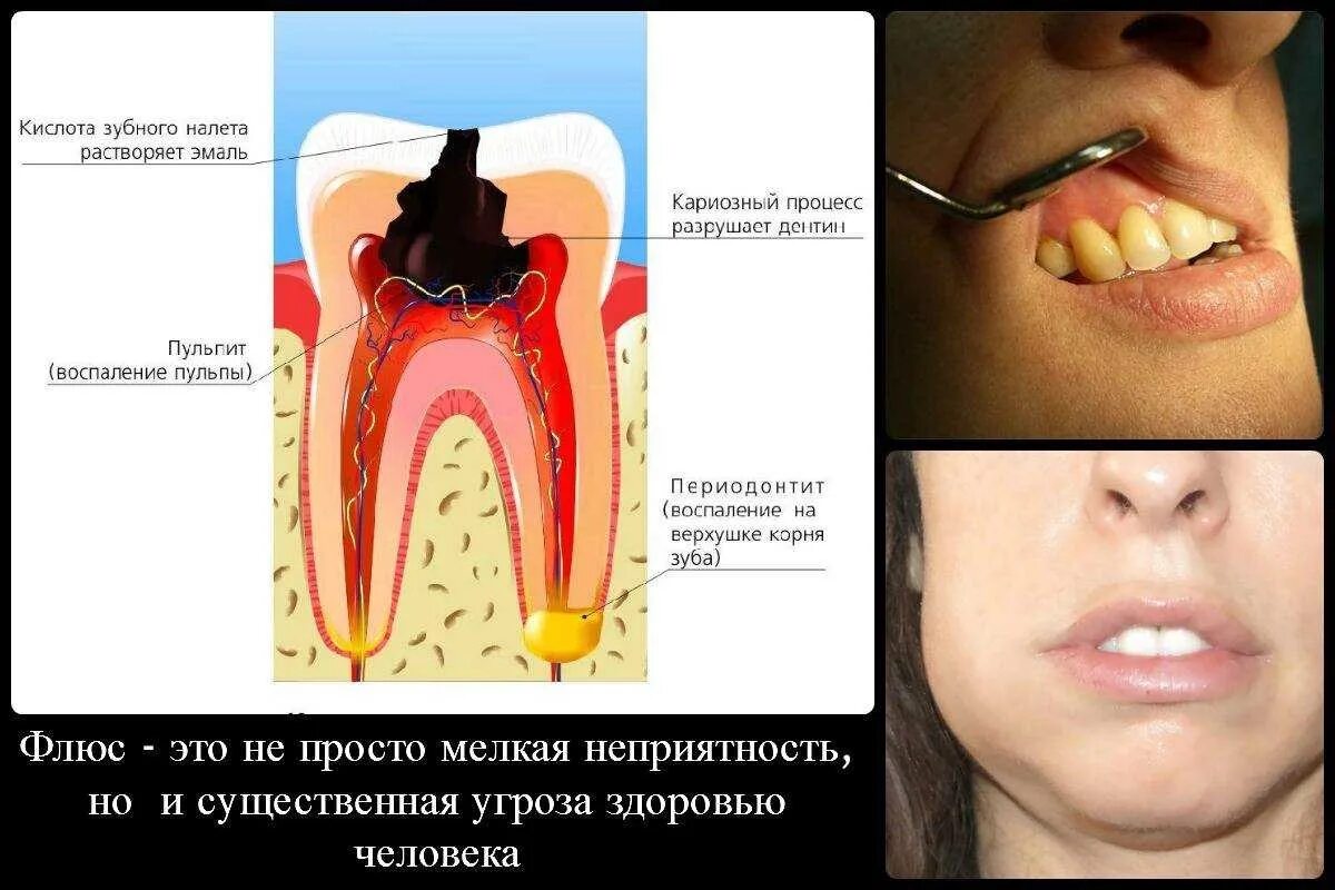 Зуб после простуды