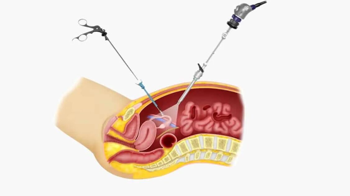 Боли в животе после удаления матки. Лапароскопическая клиновидная резекция яичников. Эндометриоз яичников операция. Киста яичника лапароскопия операции лапароскопия.