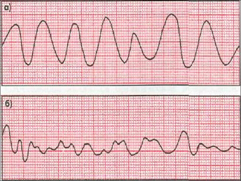Крупноволновая фибрилляция желудочков на ЭКГ. Мерцательная аритмия пленка ЭКГ. Ритм трепетания желудочков. Трепетание желудочков на ЭКГ.