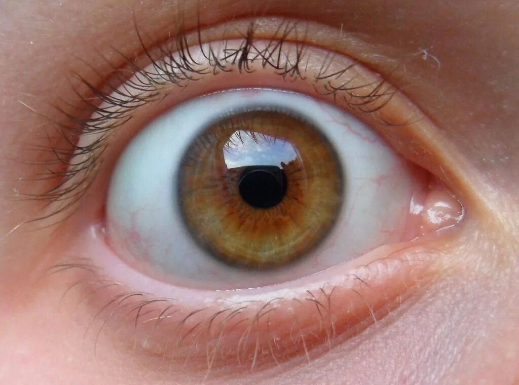 Эписклерит конъюнктивит. Белочная оболочка глаза склера. Склера человеческого глаза. Узелковый эписклерит глаза.