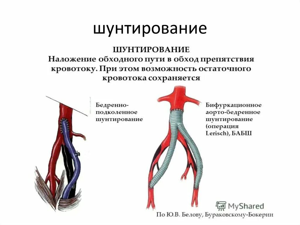 Шунтирование артерий нижних конечностей. Шунтирование артериального сосуда. Шунты в сосудистой системе. Коронарное шунтирование сосудов. Операция шунтирование сосудов.