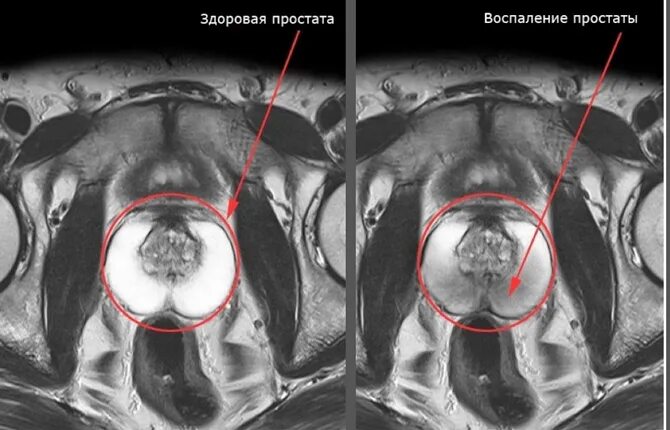 Делают мрт предстательной железы. Хронический простатит мрт.