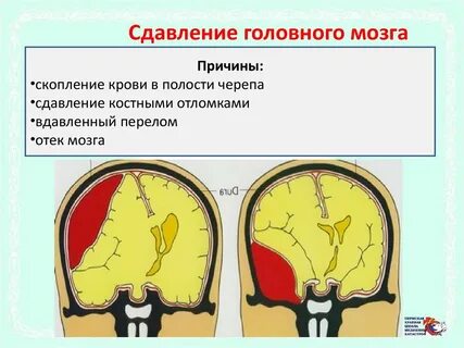 Симптомы сдавления головного мозга
