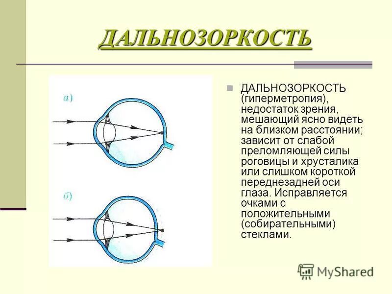 Дефекты зрения ответы. Дальнозоркость. Гиперметропия или дальнозоркость. Дальнозоркость (гиперметропия). При близорукости преломляющая сила хрусталика.