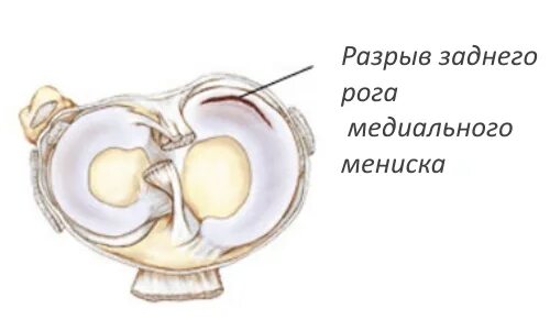 Структурные изменения заднего рога мениска. Повреждение заднего рога медиального мениска 3 степени по Stoller. Задний Рог медиального мениска. Повреждение заднего рога медиального мениска 2 степени (разрыв). Задний Рог медиального мениска коленного сустава.