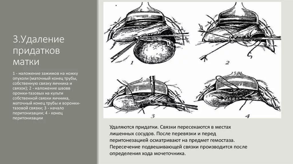 Удаление тела матки