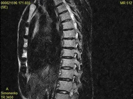 Thoracic osteochondrosis pictures Symptoms and pictures.