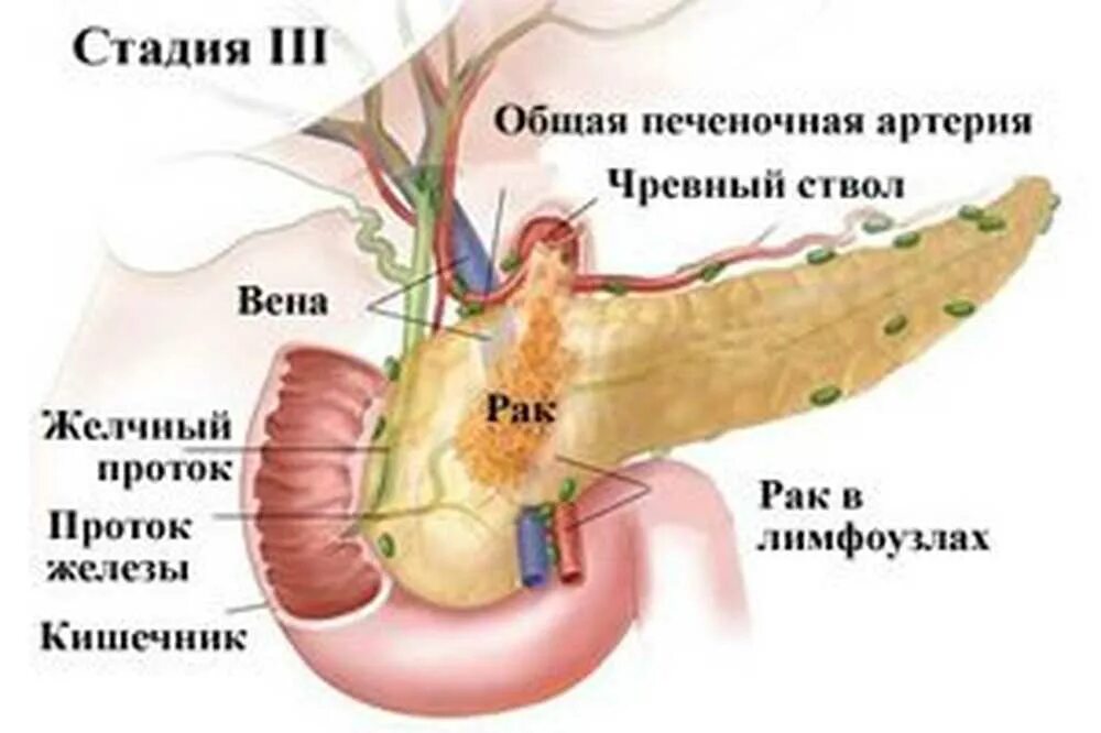 3 стадия рака поджелудочной