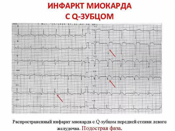 Инфаркт с зубцом q и без зубца q ЭКГ. ЭКГ при инфаркте миокарда без зубца q мелкоочаговый инфаркт миокарда. Q негативный инфаркт миокарда на ЭКГ. Инфаркт миокарда с зубцом q и без зубца q на ЭКГ. Нарушение реполяризации передне перегородочной области