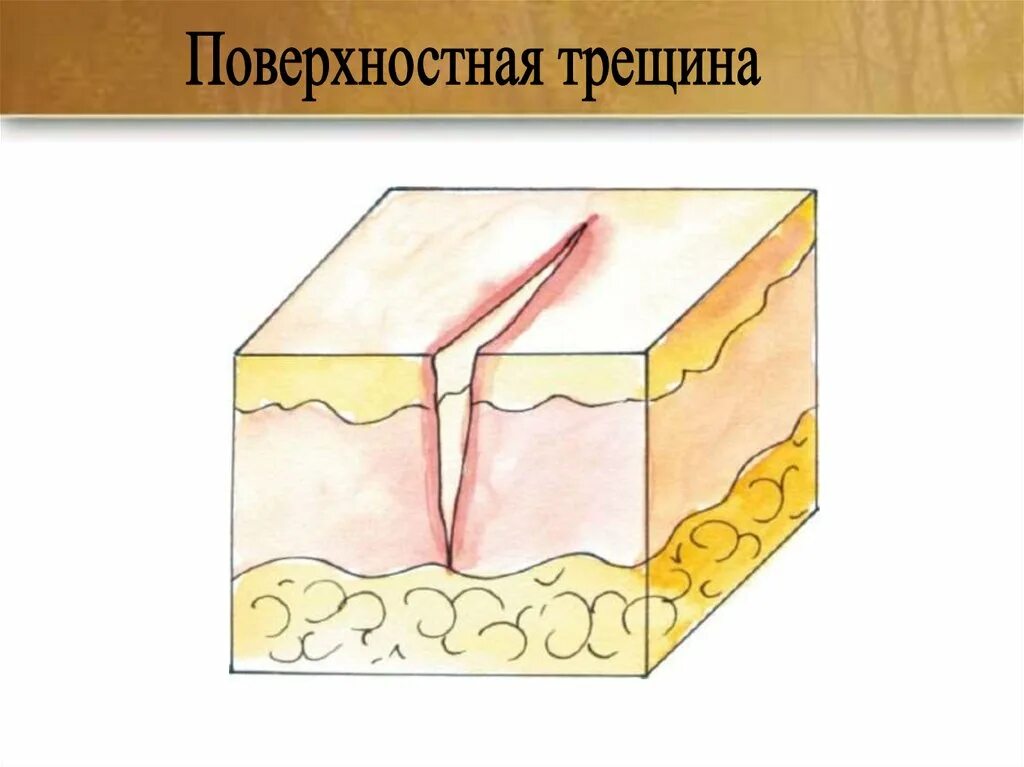 Усиление кожного рисунка. Эрозия вторичный морфологический элемент. Усиление кожного рисунка. Усиление кожного рисунка. Усиление кожного рисунка.