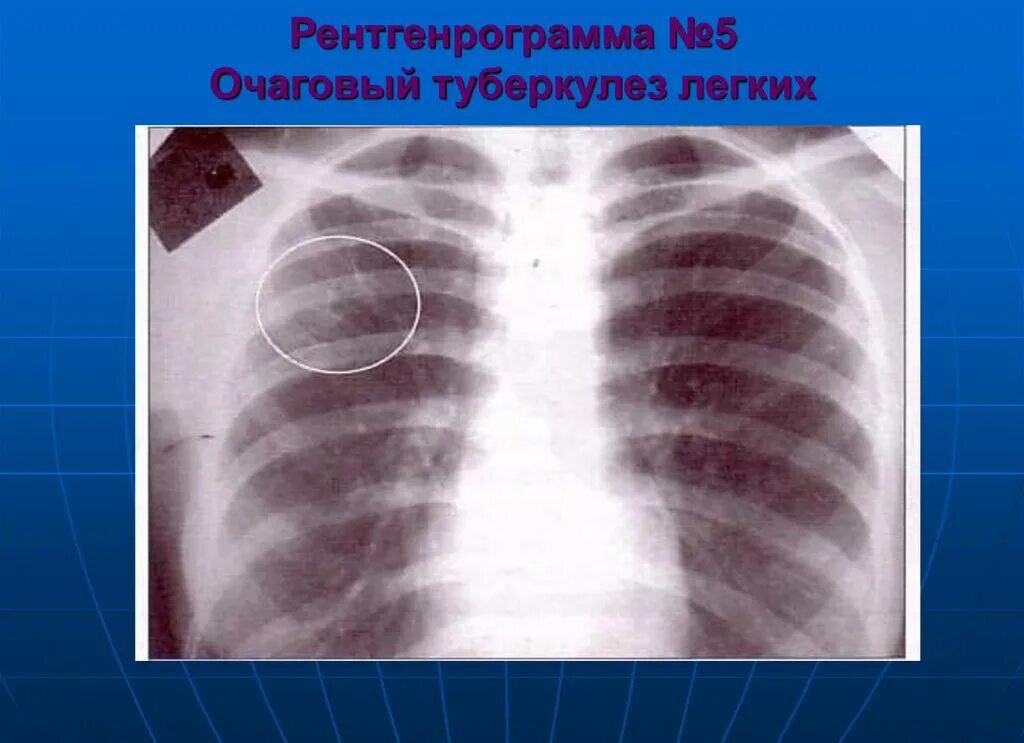 Очаговое поражение легких. Очаговый туберкулез легких. Очаговый туберкулез рентген. Хронический очаговый туберкулез.