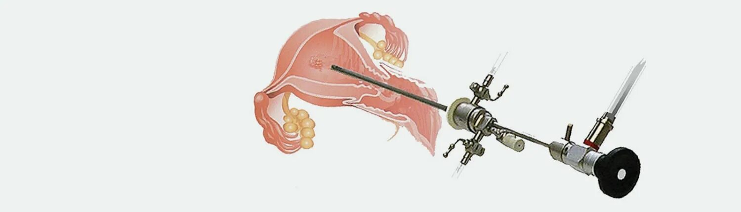 Лапароскопия миомы матки. Гистерэктомия матки лапароскопическим методом. Влагалищная тотальная гистерэктомия. Операция гистерэктомия. Гистерэктомия что это такое простыми словами