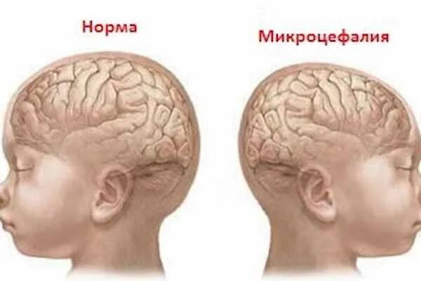 Микроцефалия причины. Микроцефалия головного мозга у ребенка. Микроцефалия, гидроцефалия, церебральная кальцификация. Микроцефальная форма головы у грудничка. Микроцефалия и макроцефалия это.