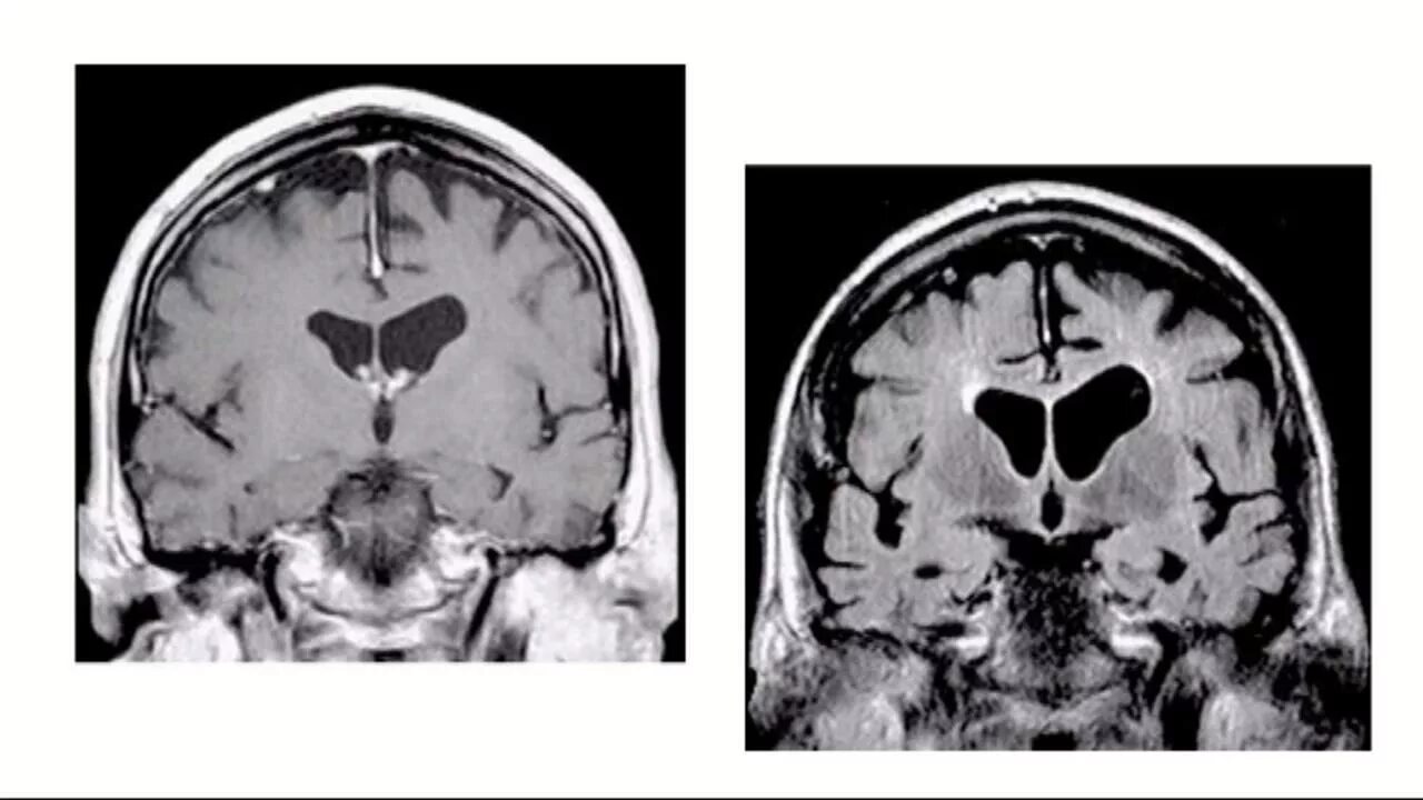 Диффузная атрофия головного мозга. Кт и мрт при болезни Альцгеймера. Мрт головного мозга болезнь Альцгеймера. Болезнь Альцгеймера мрт. Атрофия головного мозга на кт.