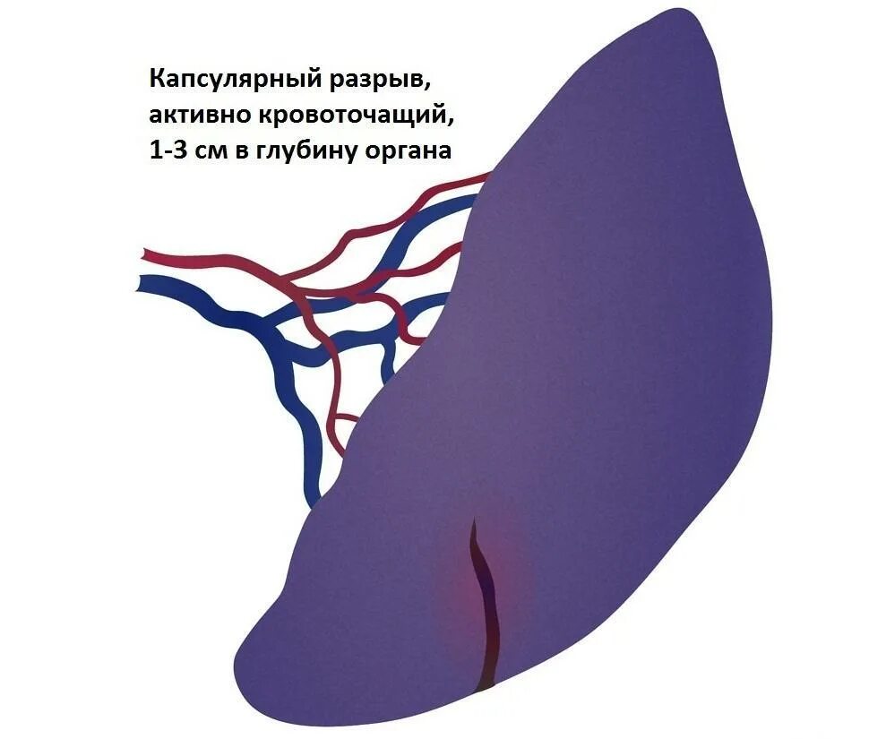 Разрыв капсулы селезенки. Чрезкапсульный разрыв селезенки. Одномоментный разрыв селезенки. Селезенка 40