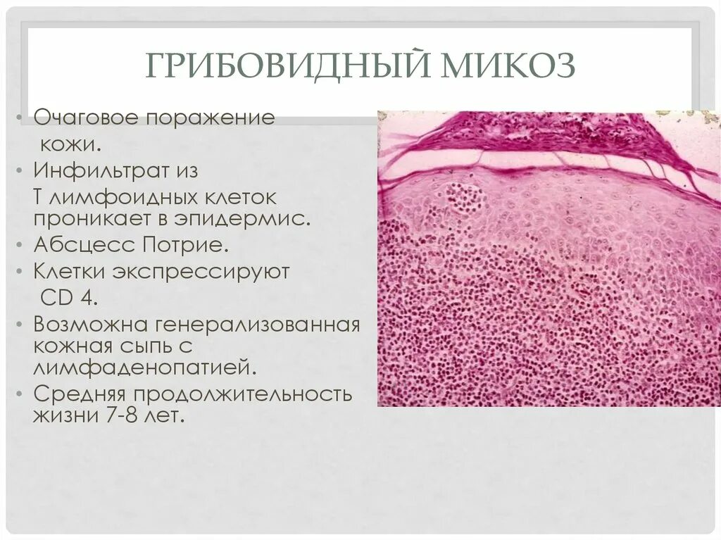 Тесты нмо грибовидный микоз по утвержденным клиническим