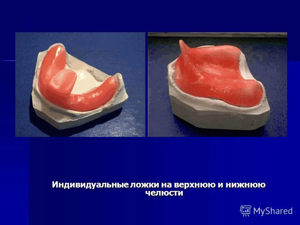 Материал базисов съемных протезов