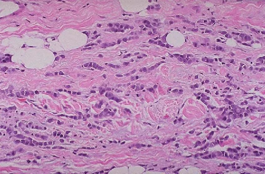 На фоне фиброзных изменений. Скирр молочной железы микропрепарат. Скирр желудка патанатомия.