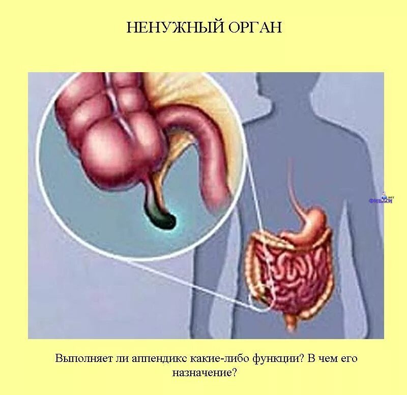 Аппендикс у животных. Перитонит гангренозный аппендикс. Гнойный аппендицит с перитонитом.