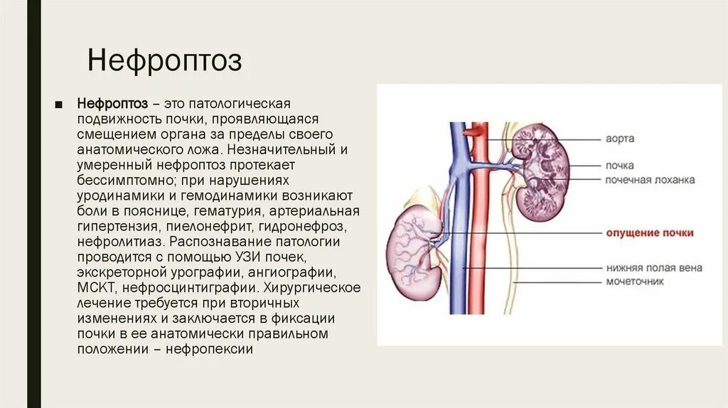 Диффузная почка что это значит. Нефроптоз почки урография. Что такое нефроптоз почек 1 степени справа. Нефроптоз почек 2 степени. Нефроптоз 1 степени правой почки.