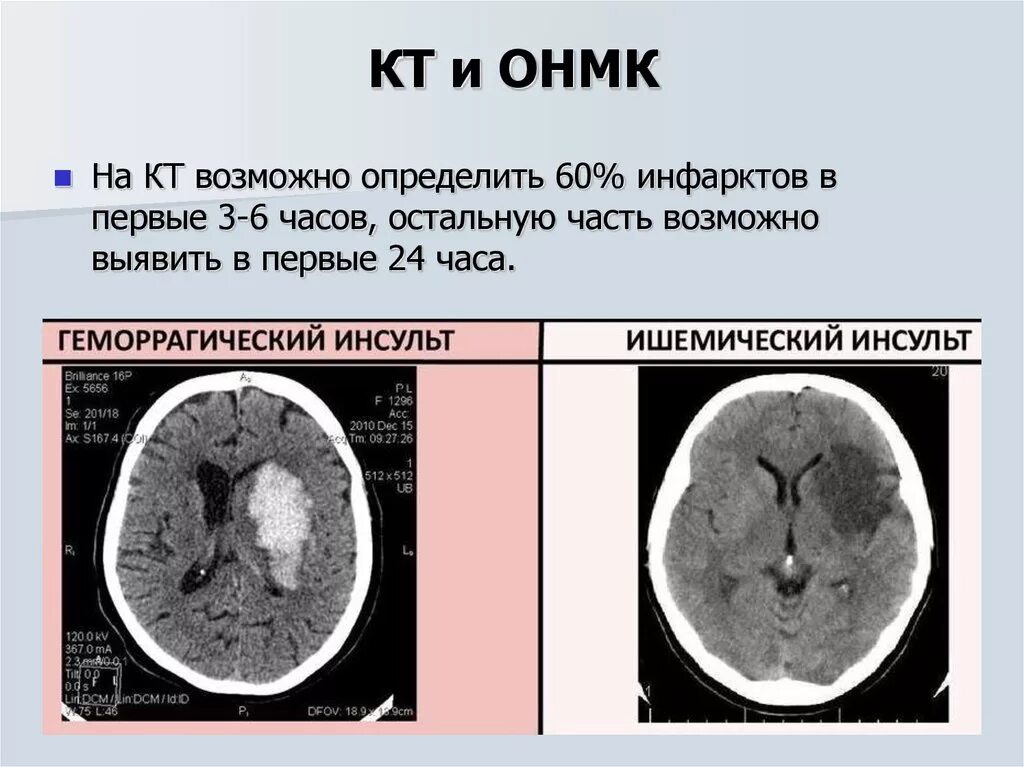 Ишемический инсульт кт и мрт. ОНМК по ишемическому типу кт. Геморрагический инсульт кт. Ишемический инсульт кт картина.