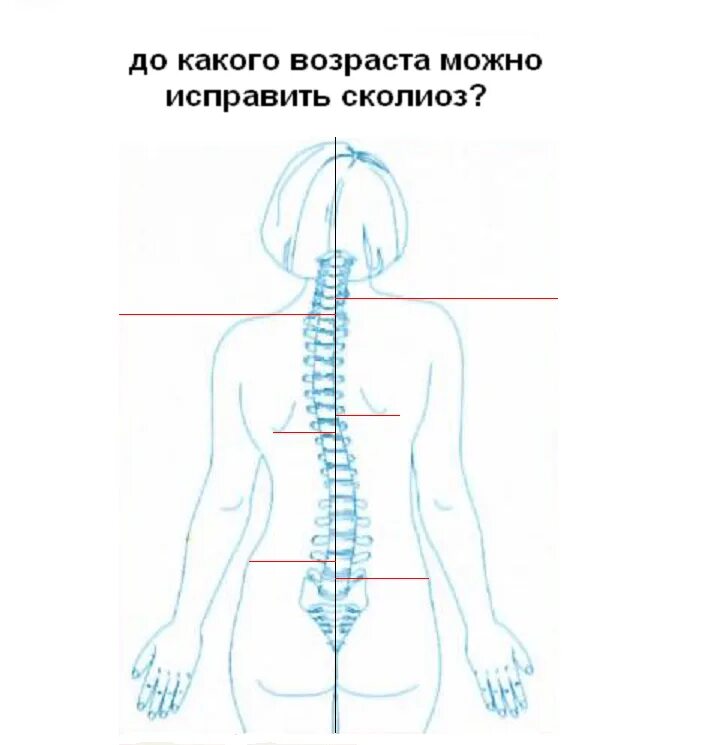 До скольки лет можно исправить. Сколиоз рисунок.